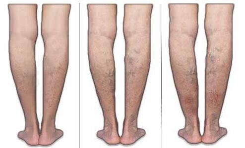 Phase of varicose veins