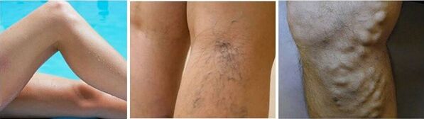 The appearance of the varicose veins on the legs