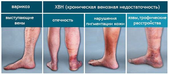 Phase of varicose veins