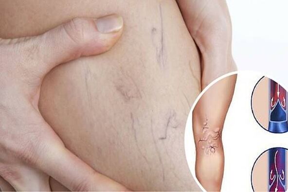 Photo of varicose veins