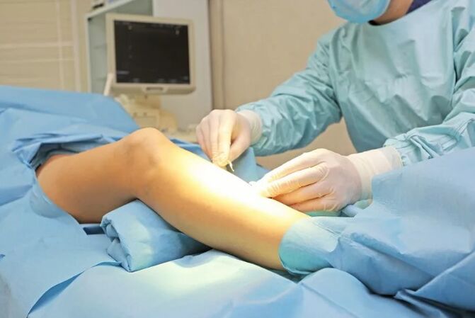 Operation for the removal of the veins on the legs