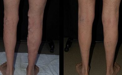 Treatment of varicose veins with a laser photo before and after