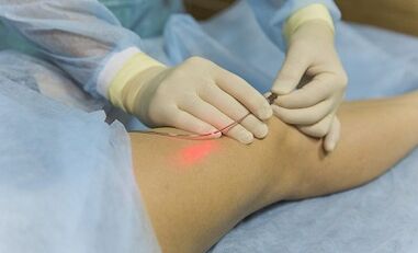 Treatment of varicose veins with a laser