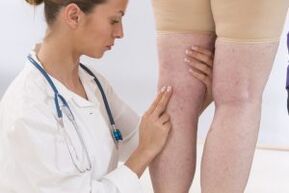 The phlebologist examines the patient with varicose veins