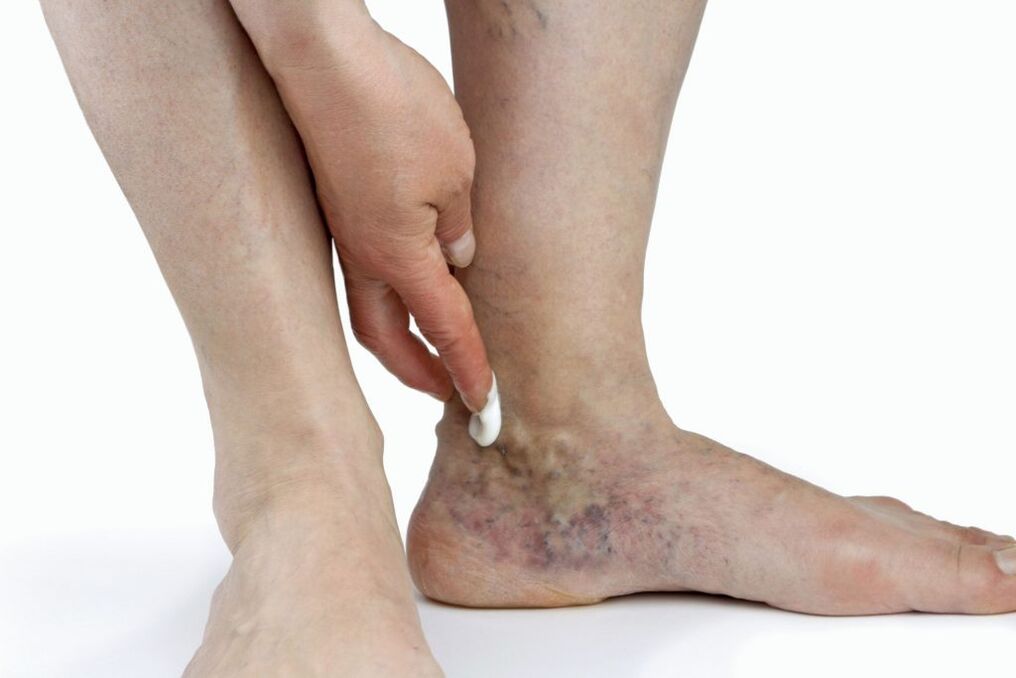 Varicose veins of the lower limbs