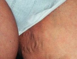 Varicose veins of the pelvis